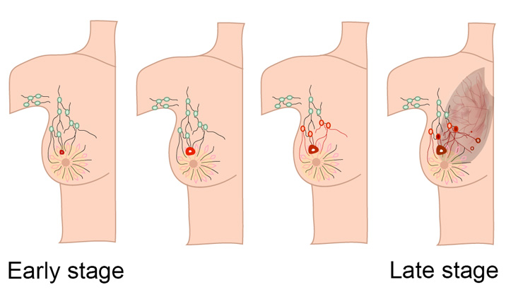 lung-cancer-in-males-breast-cancer-in-females-high-in-valley
