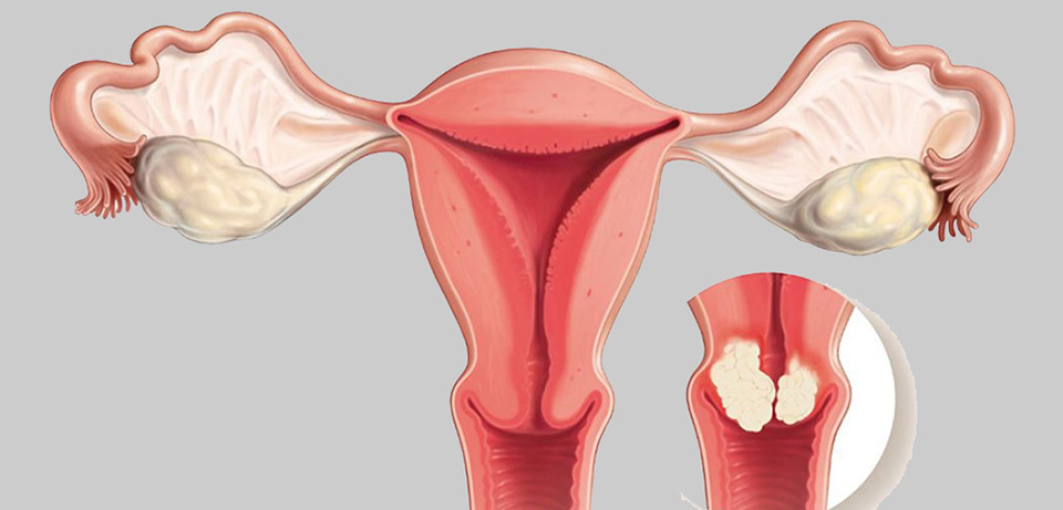 rise-in-cervical-cancer-due-to-covid-19-lockdown