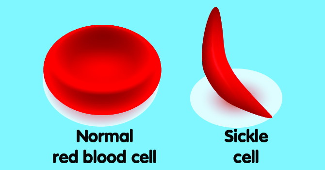 early-diagnosis-counselling-key-to-prevent-sickle-cell-diseases