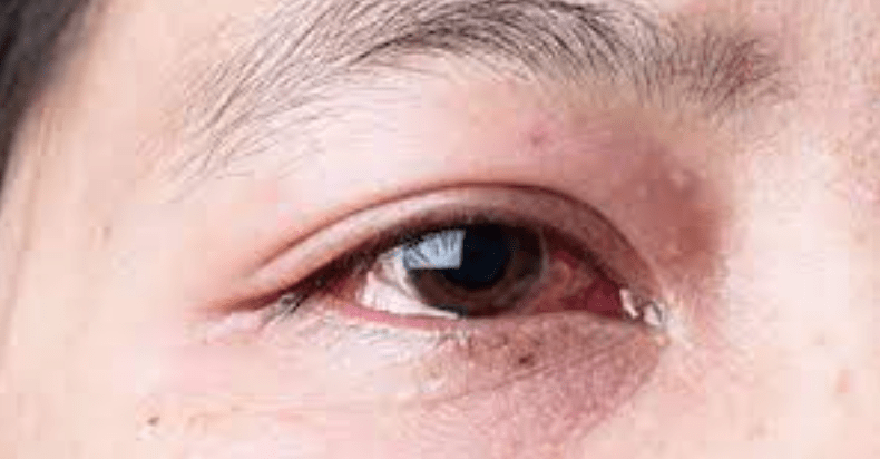 eye-infection-cases-rise-after-air-pollution