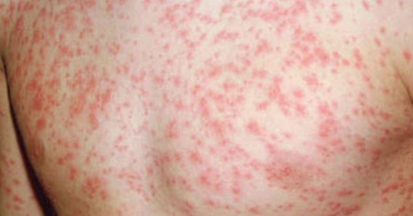 caseso-of-measles-being-reported-again