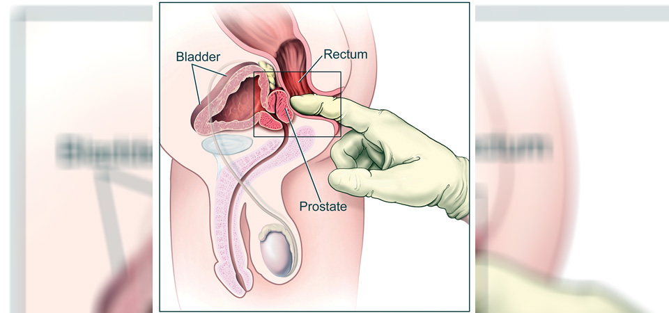 prostate-cancer-symptoms-and-signs